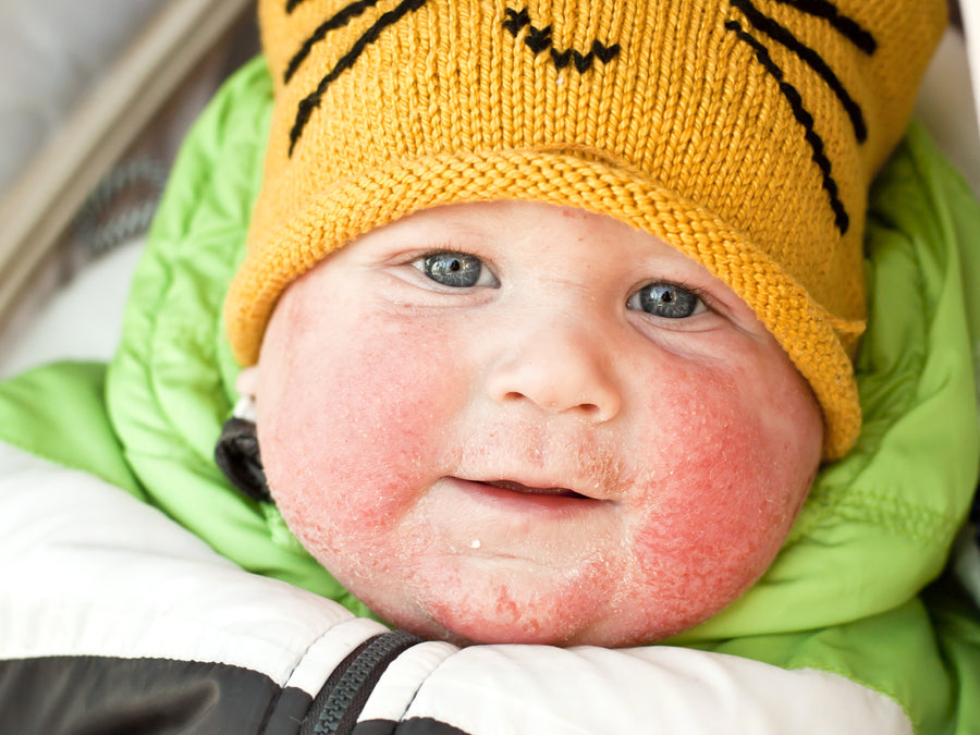 Does Baby Eczema Go Away?