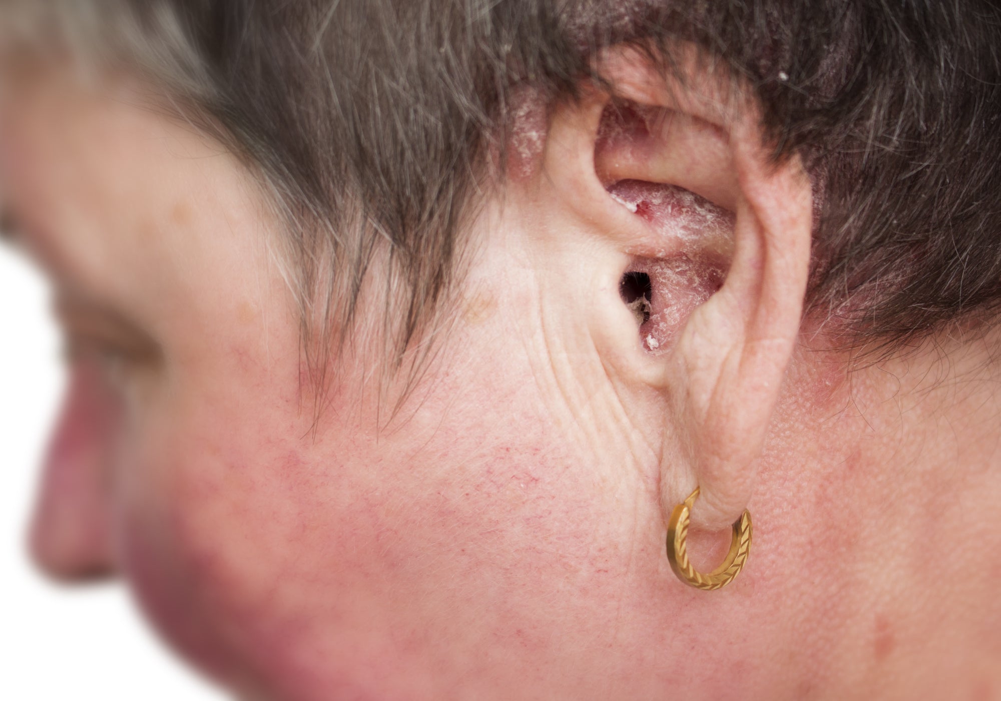 Can You Cure Aural Dermatitis/Ear Eczema?
