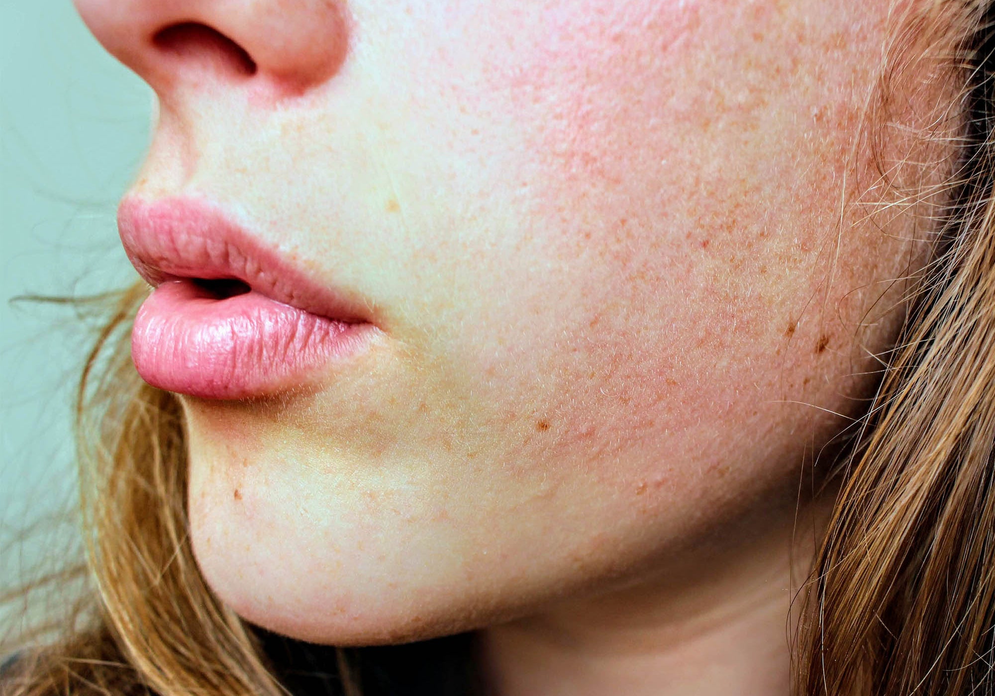 Summer Skincare For Rosacea