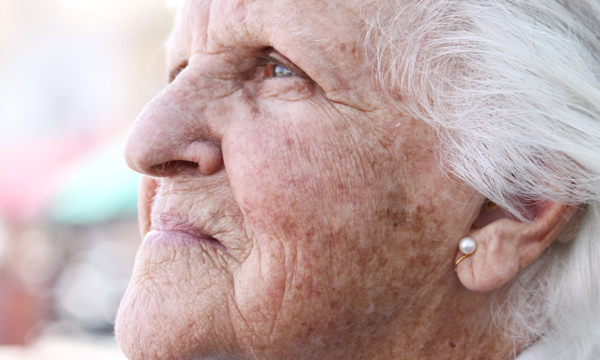 A person staring into the distance with signs of Actinic Keratosis on face.