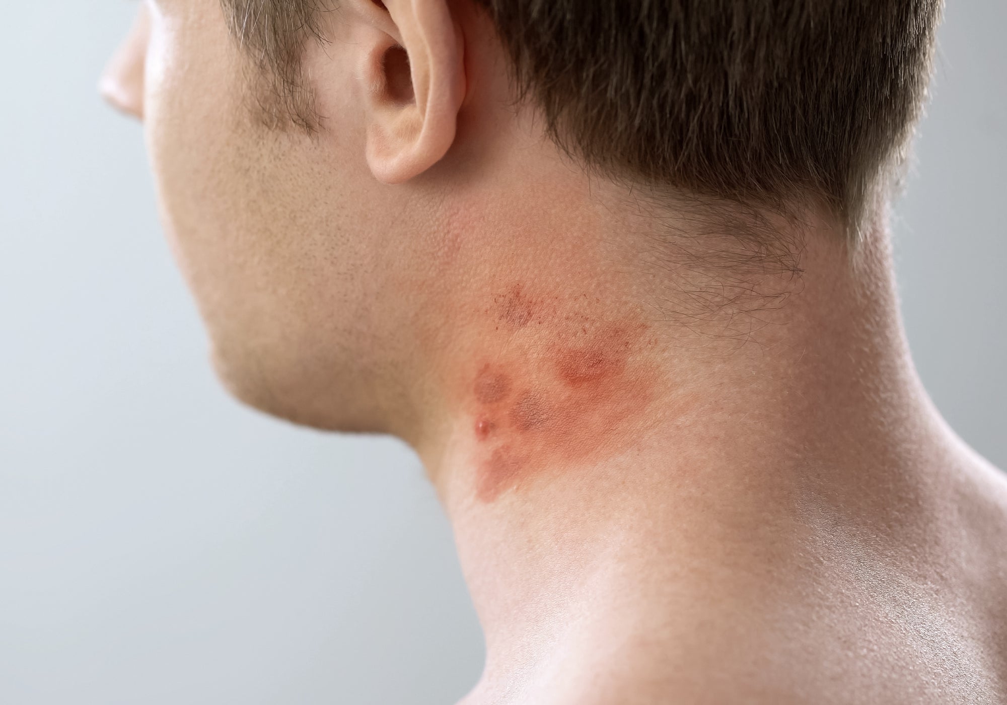 Can Contact Dermatitis Look Like Acne?