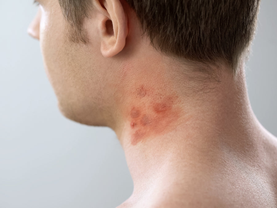 Can Contact Dermatitis Look Like Acne?