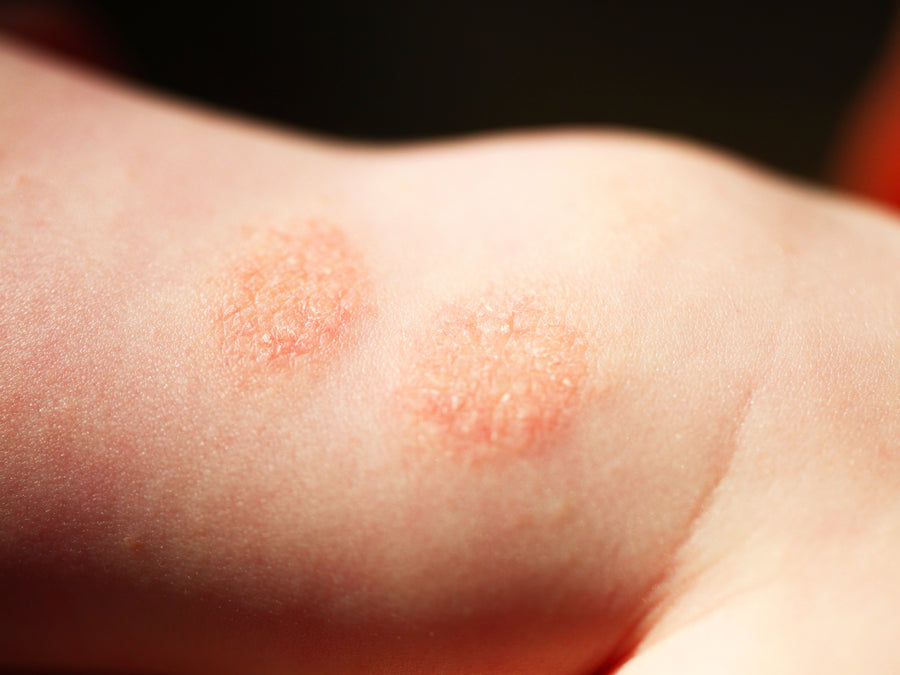 Discoid Eczema on the skin