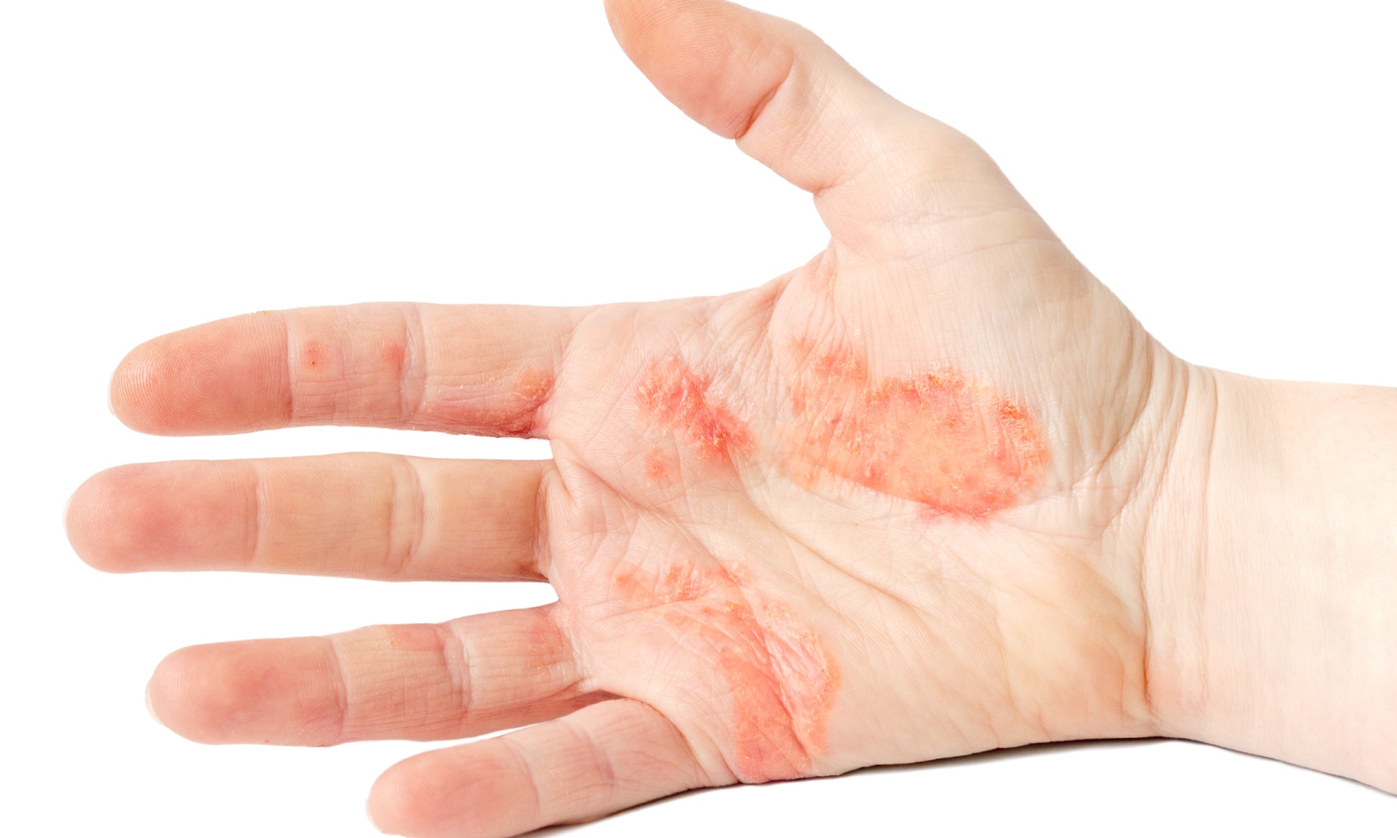 Dyshidrosis on the palm of a hand