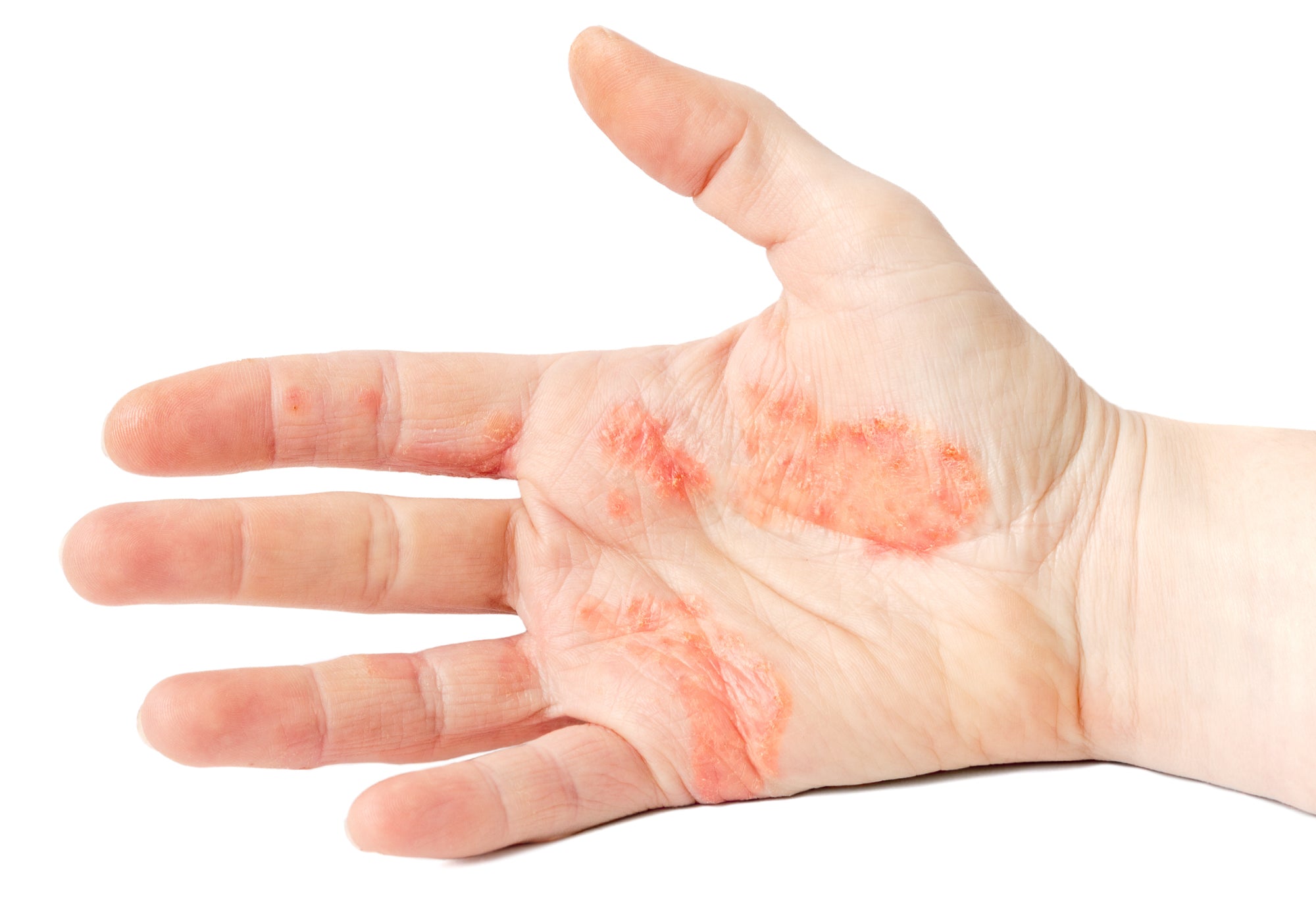 Dyshidrosis on the palm of a hand