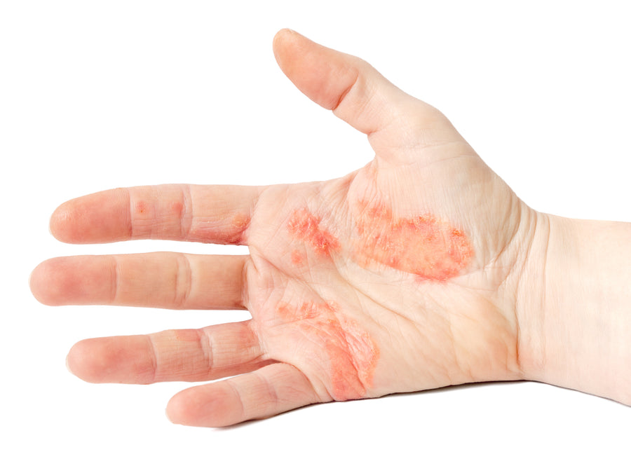 Dyshidrosis on the palm of a hand