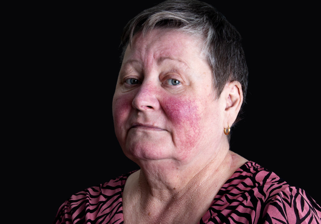 Example of Rosacea