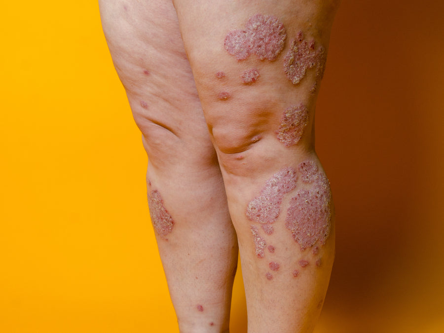 Can Psoriasis Be A Symptom Of Something Else?