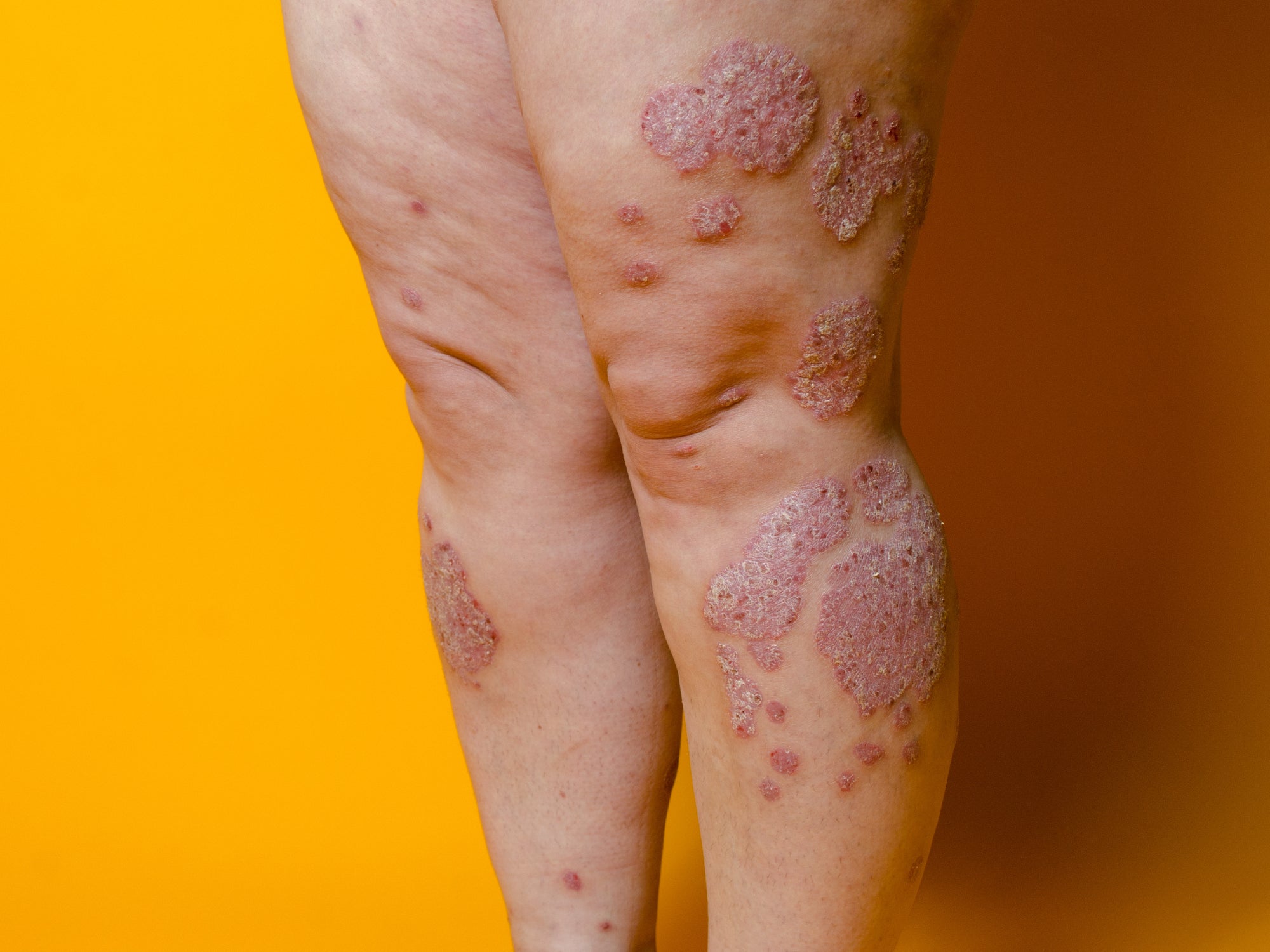 Can Psoriasis Be A Symptom Of Something Else?