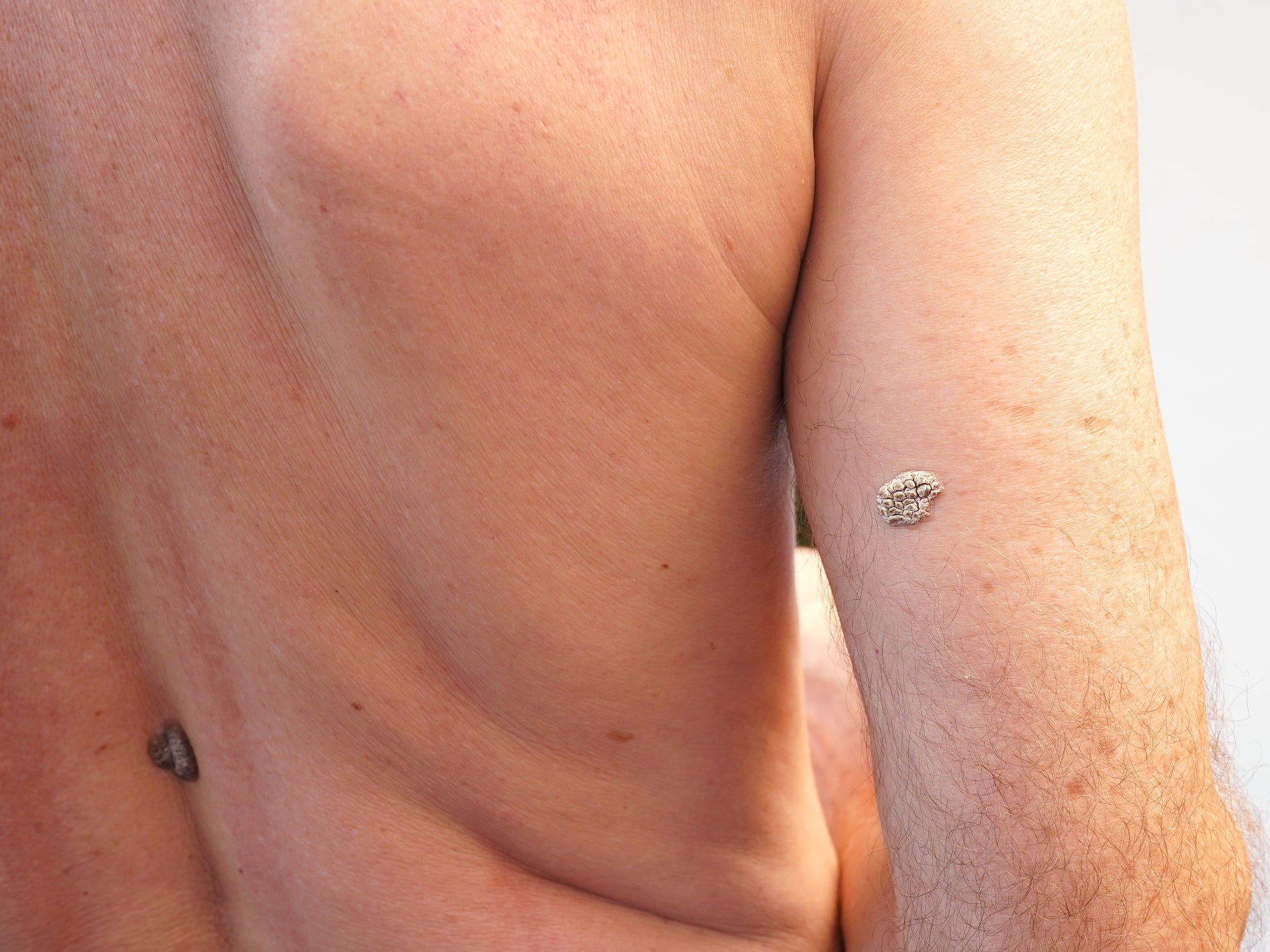 2 examples of keratosis on the back of the arm and back