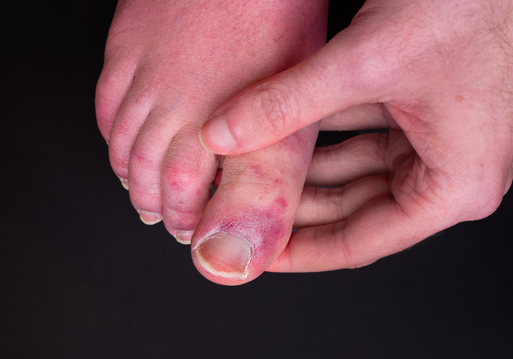rash on toes