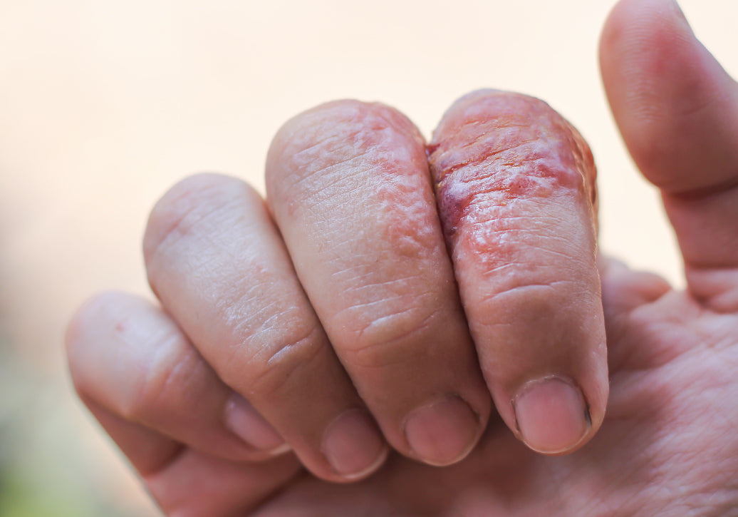 rash on fingers