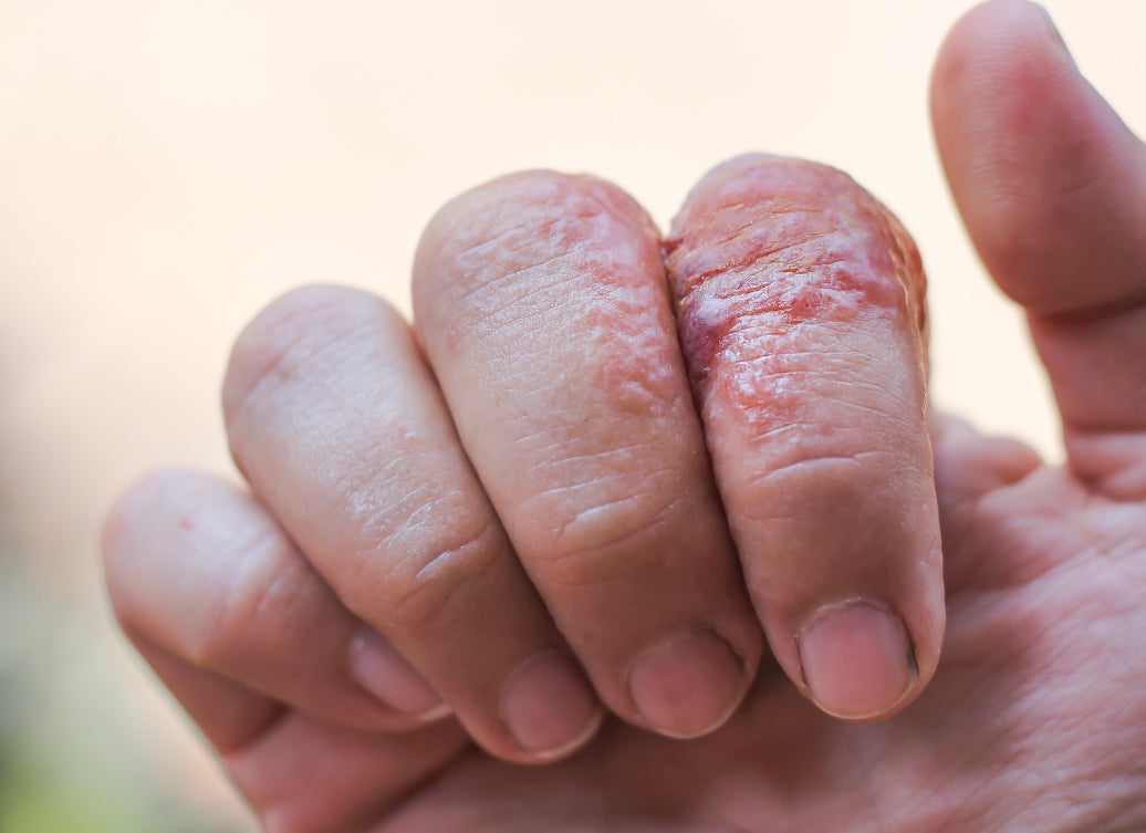 Sti Rash Hands Heat Rash On Hands