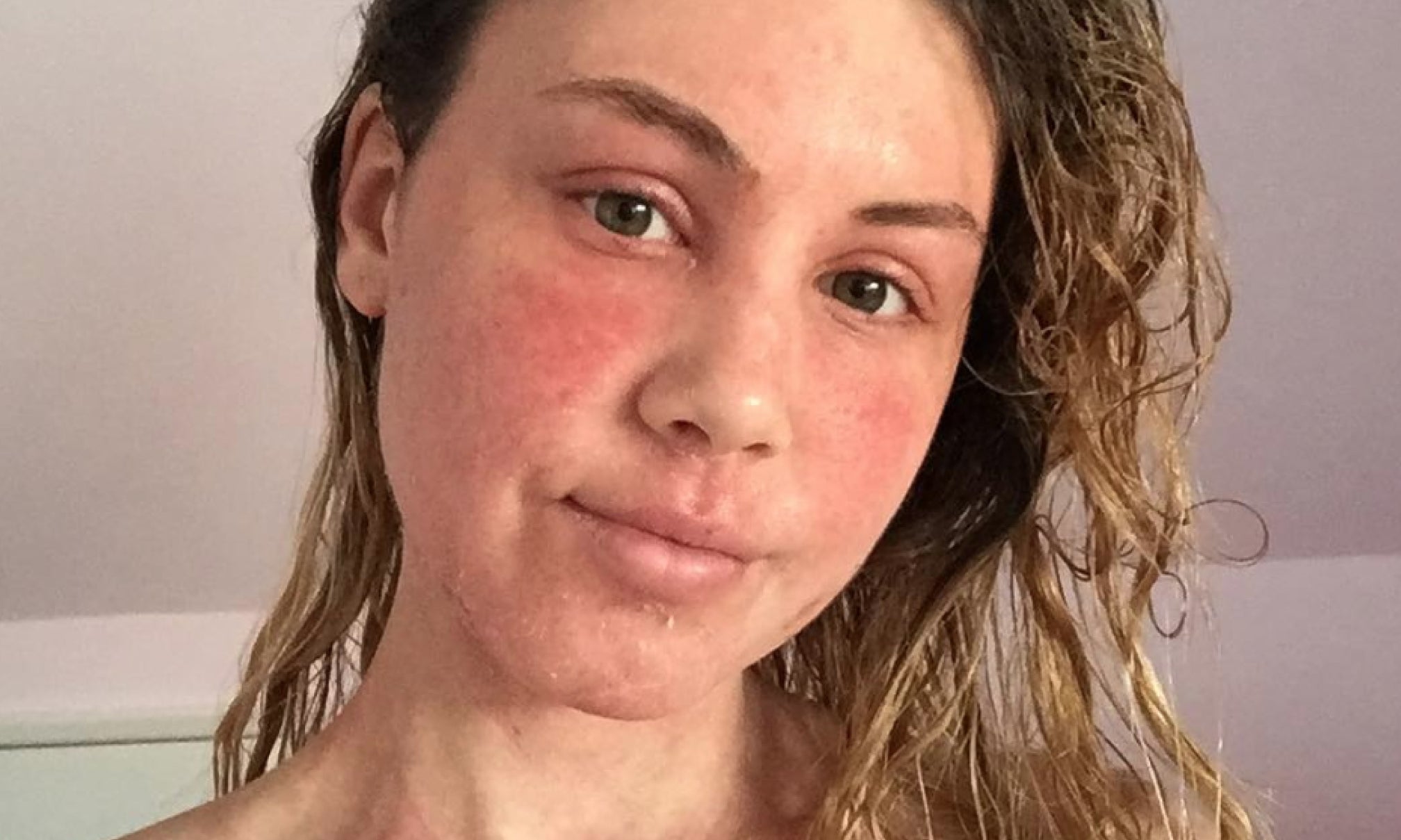 Does Diet Effect Red Skin Syndrome/Topical Steroid Withdrawl (TSW)?