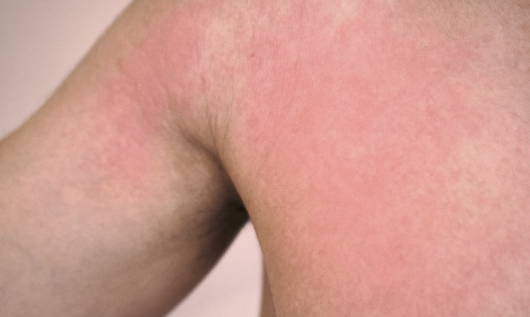 An example of Polymorphic Light Eruption on the arm, shoulder and torso