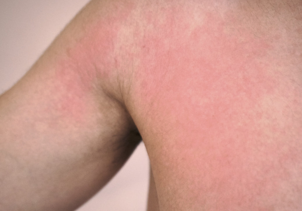 An example of Polymorphic Light Eruption on the arm, shoulder and torso