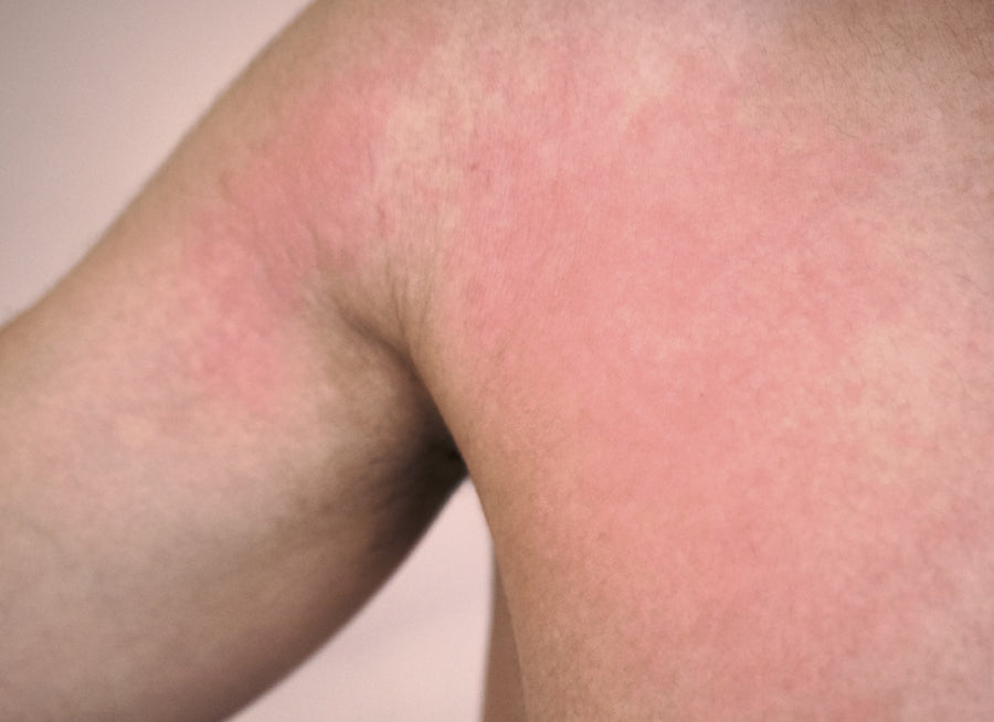 An example of Polymorphic Light Eruption on the arm, shoulder and torso