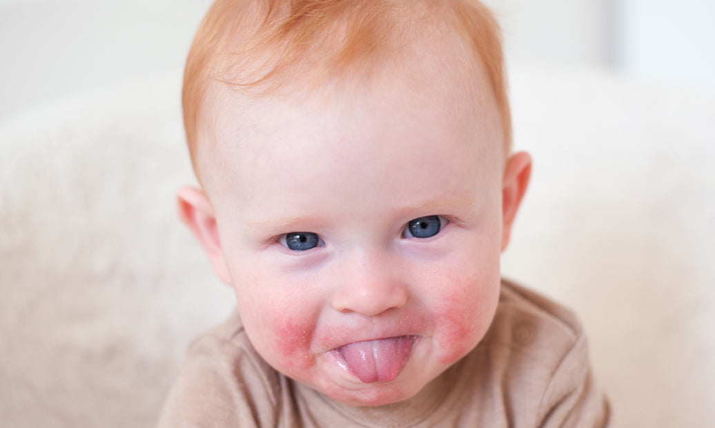 A baby with eczema on cheeks