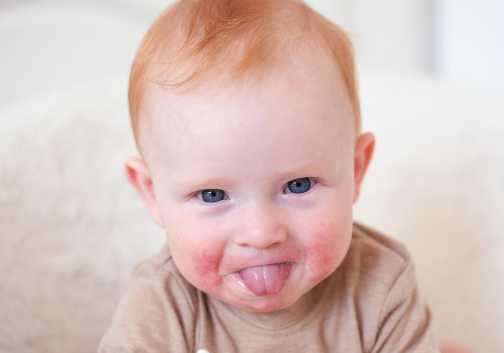 A baby with eczema on cheeks