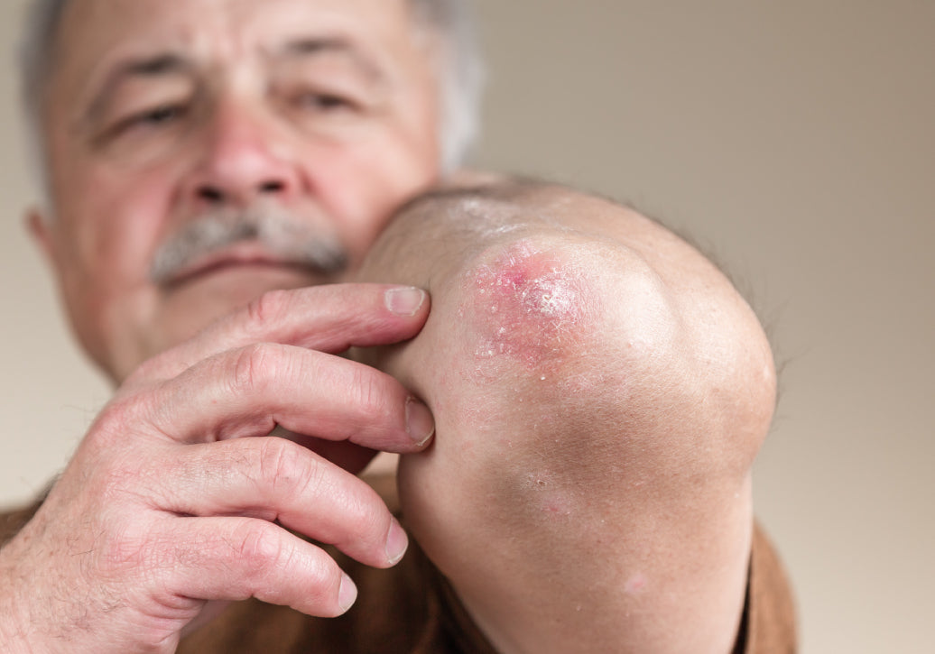 psoriasis on elbow