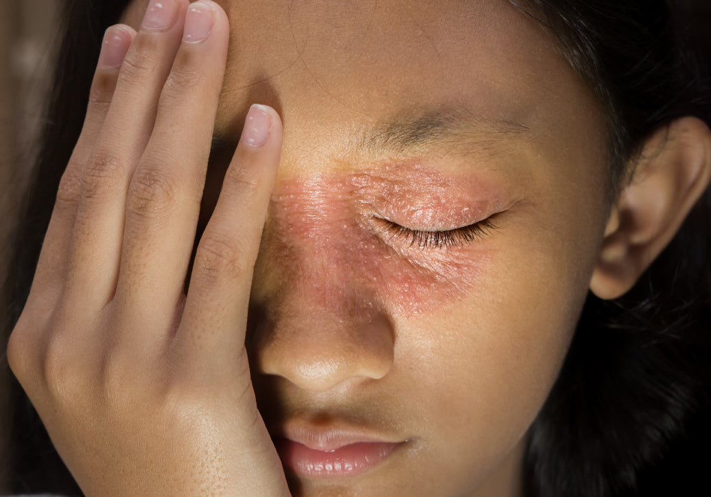 Example of Periocular Dermatitis
