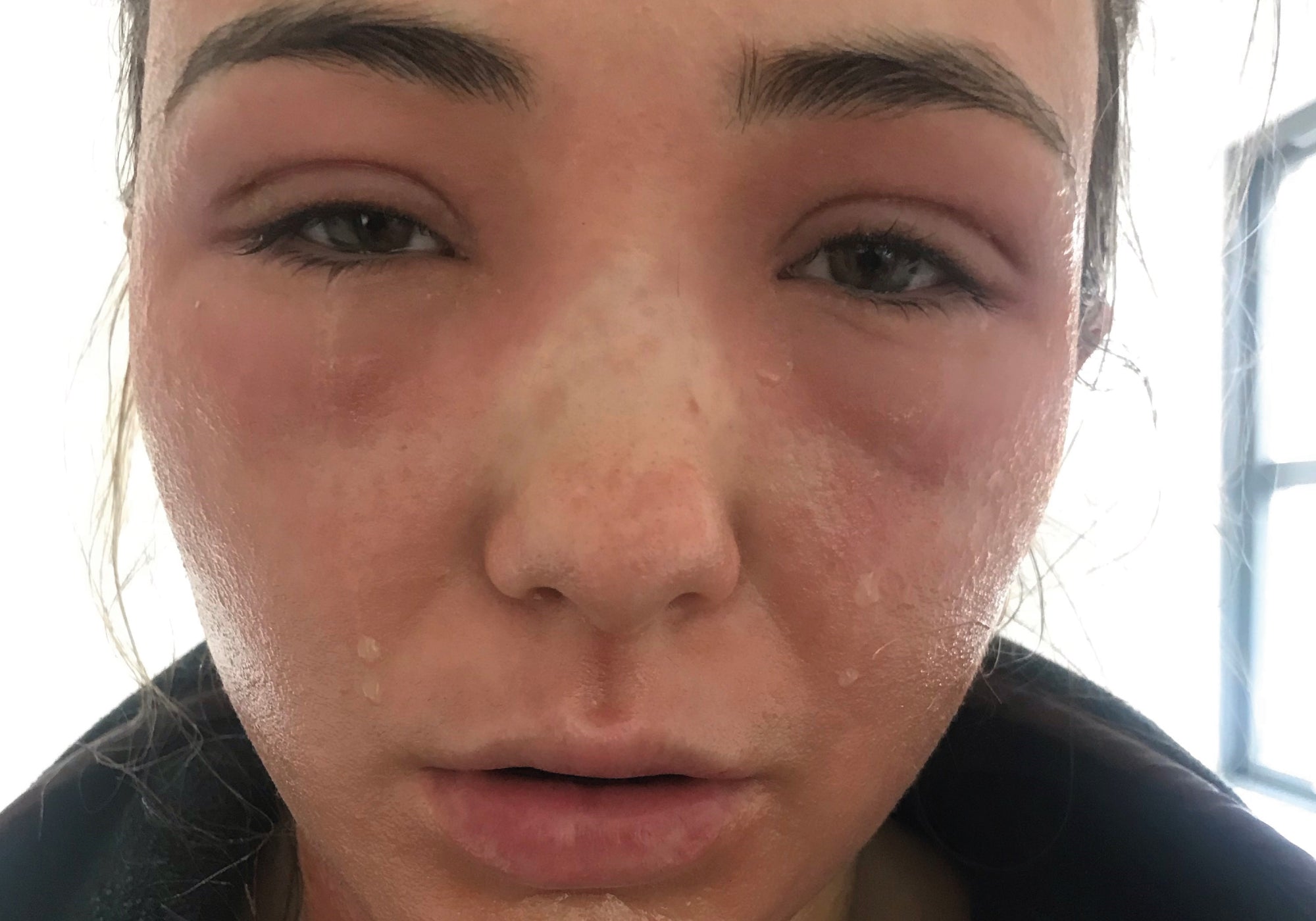 My Imperfect Skin: A Topical Steroid Withdrawal Journey Through Social Media