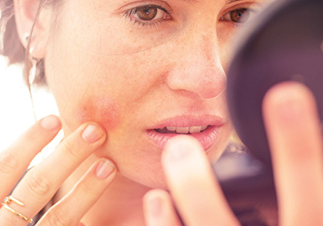 Never Had Eczema Before: What Triggers Eczema In Adults?