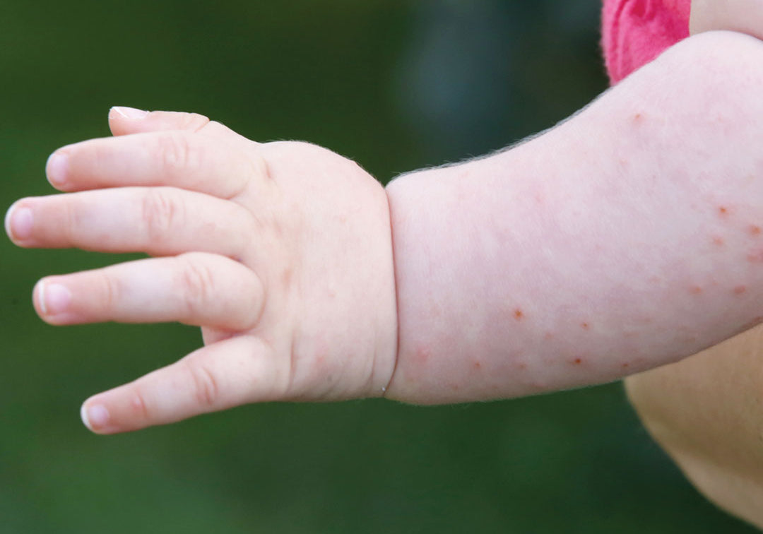 Is Your Eczema Cream Giving You An Itchy Rash?