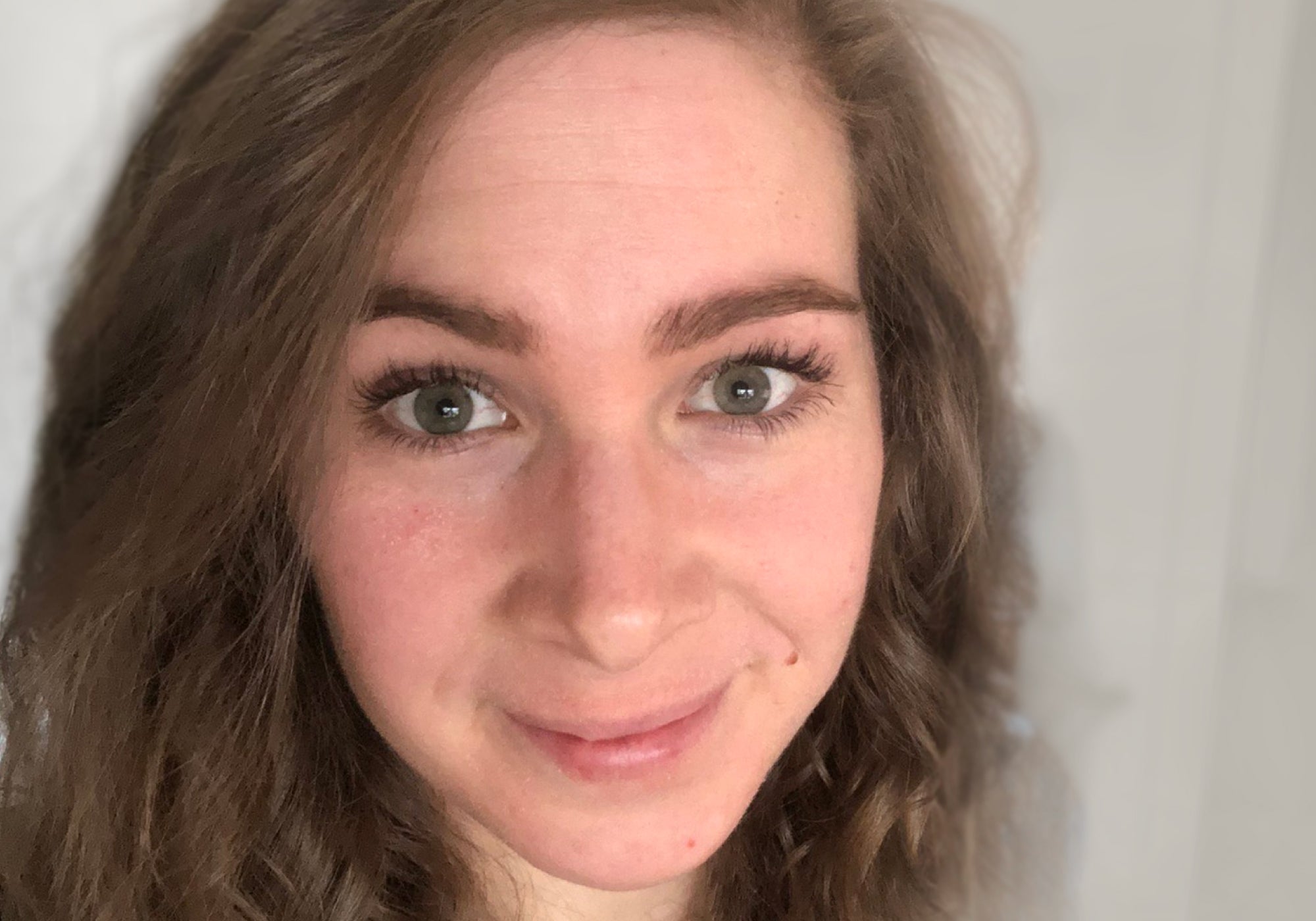 Topical Steroid Withdrawal: How TSW Puts Your Life On Hold