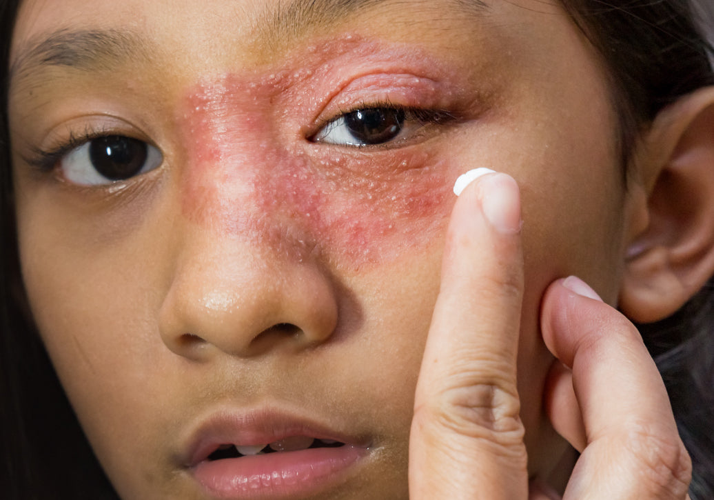 Young woman with dermatitis around the eyes
