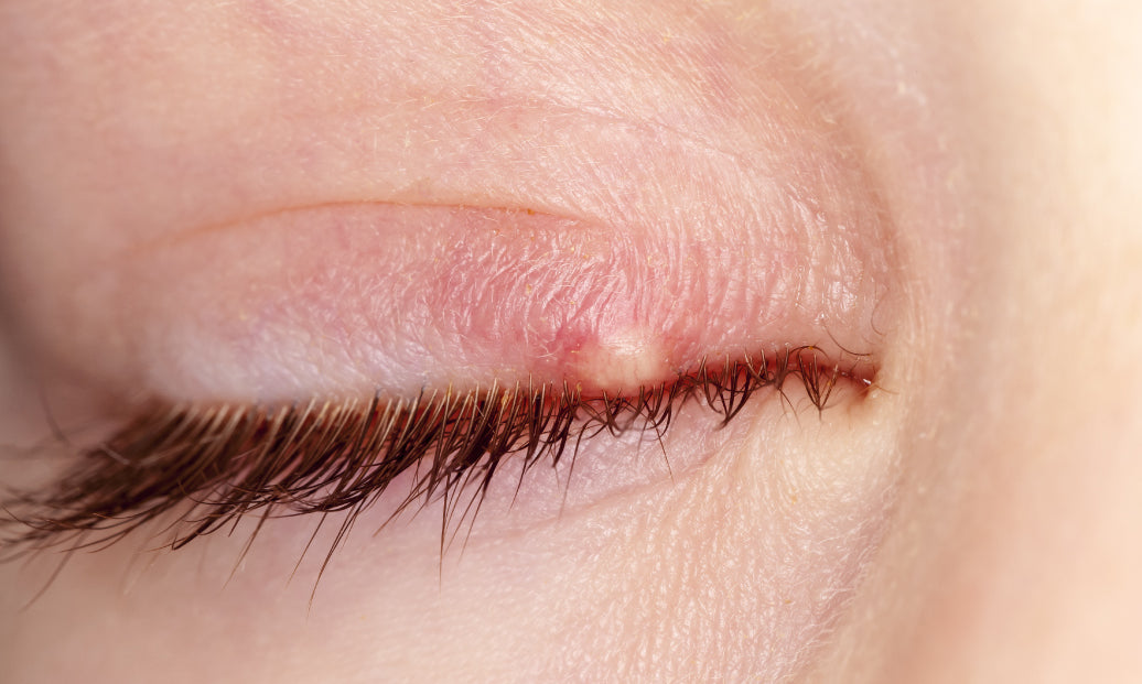 Blepharitis on the eye lid