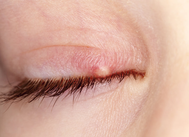 Blepharitis on the eye lid
