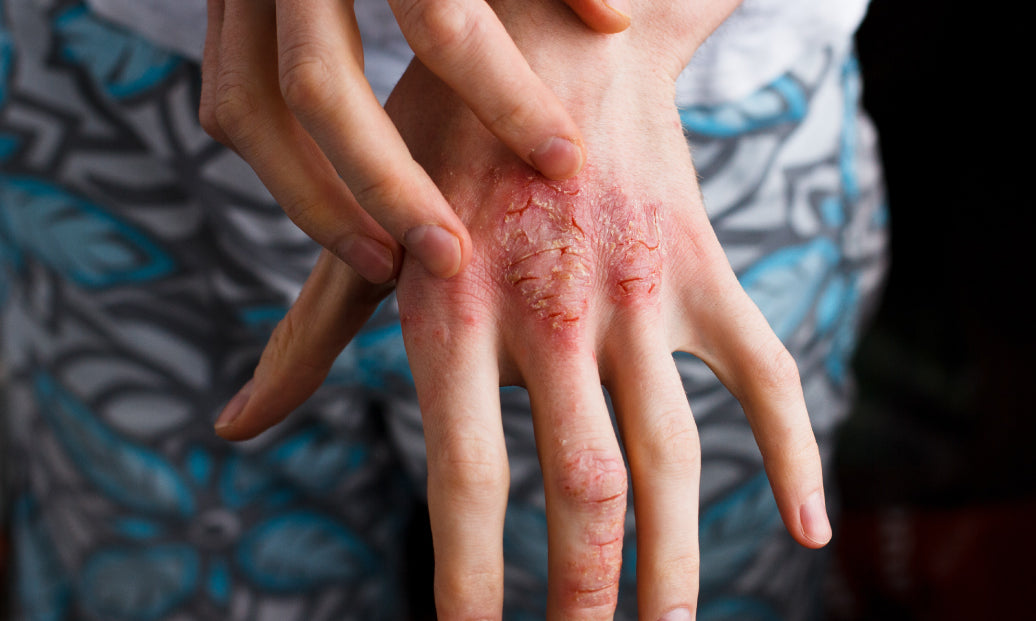 dry, red skin on the back of a hand