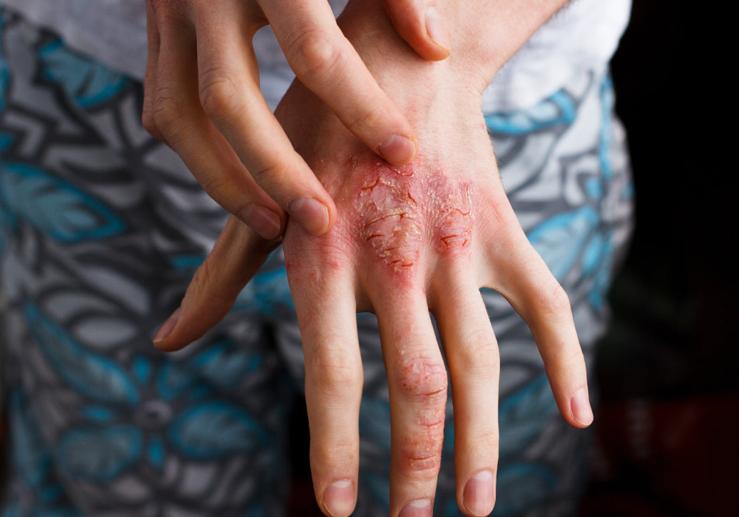 dry, red skin on the back of a hand