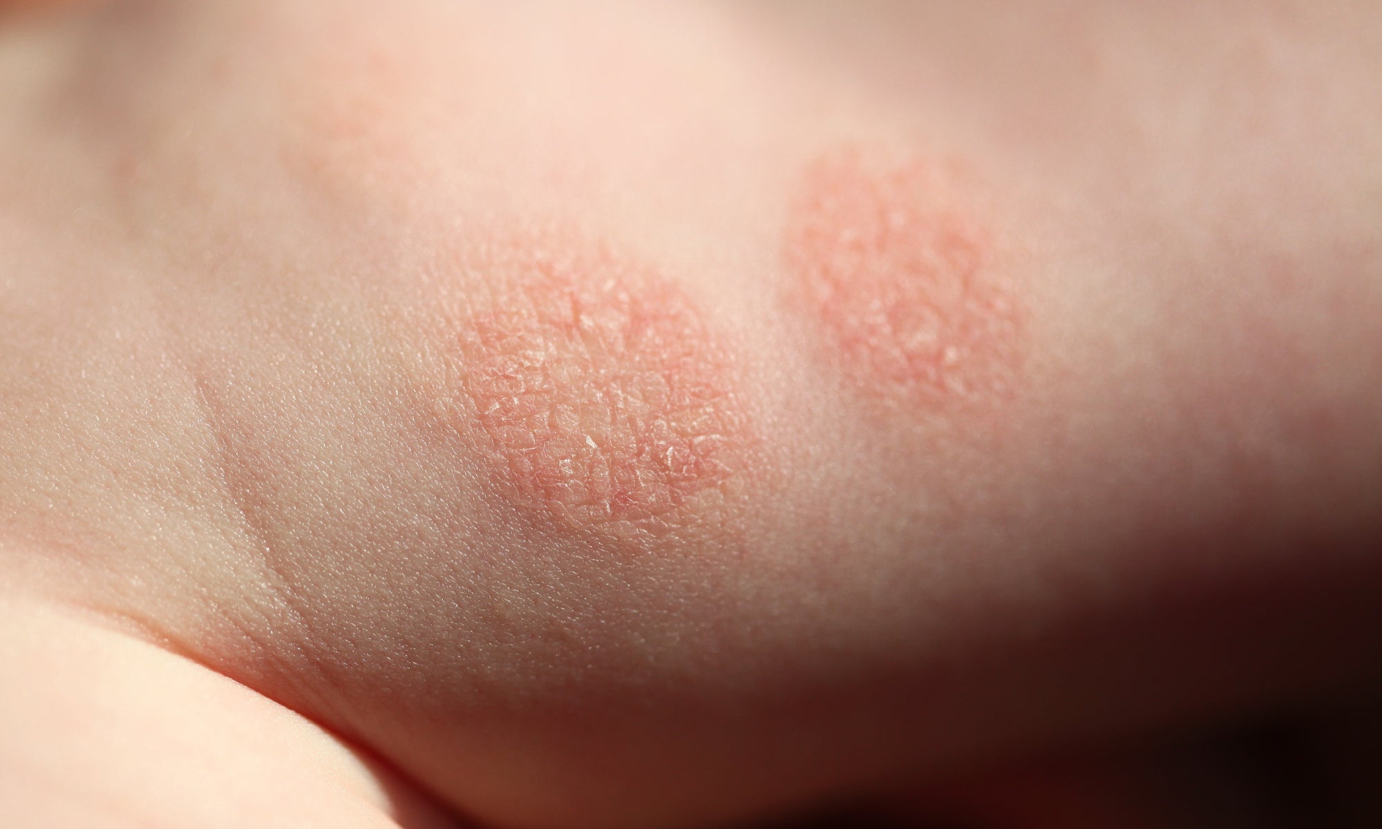 How Common Is Discoid Eczema?