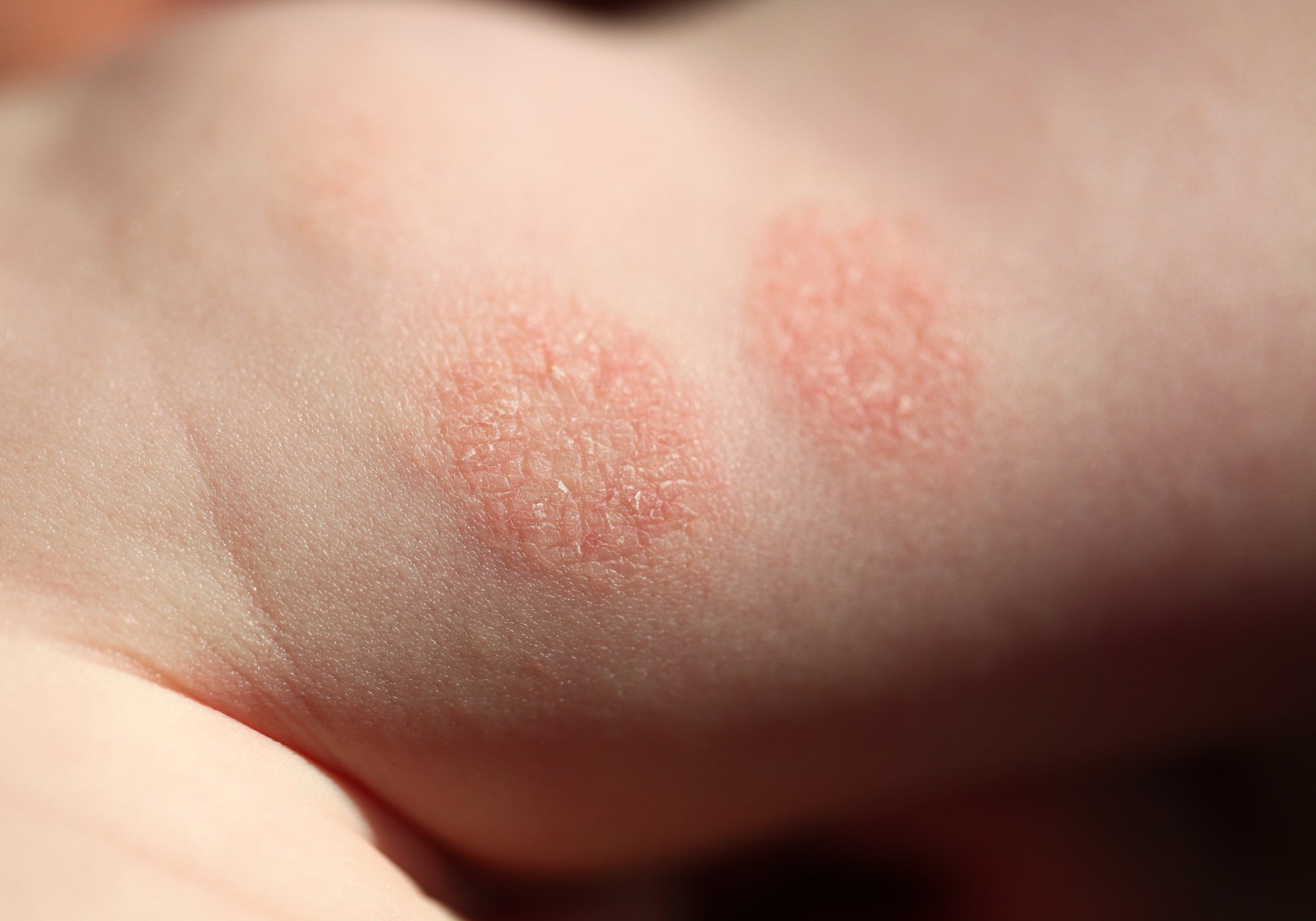 How Common Is Discoid Eczema?
