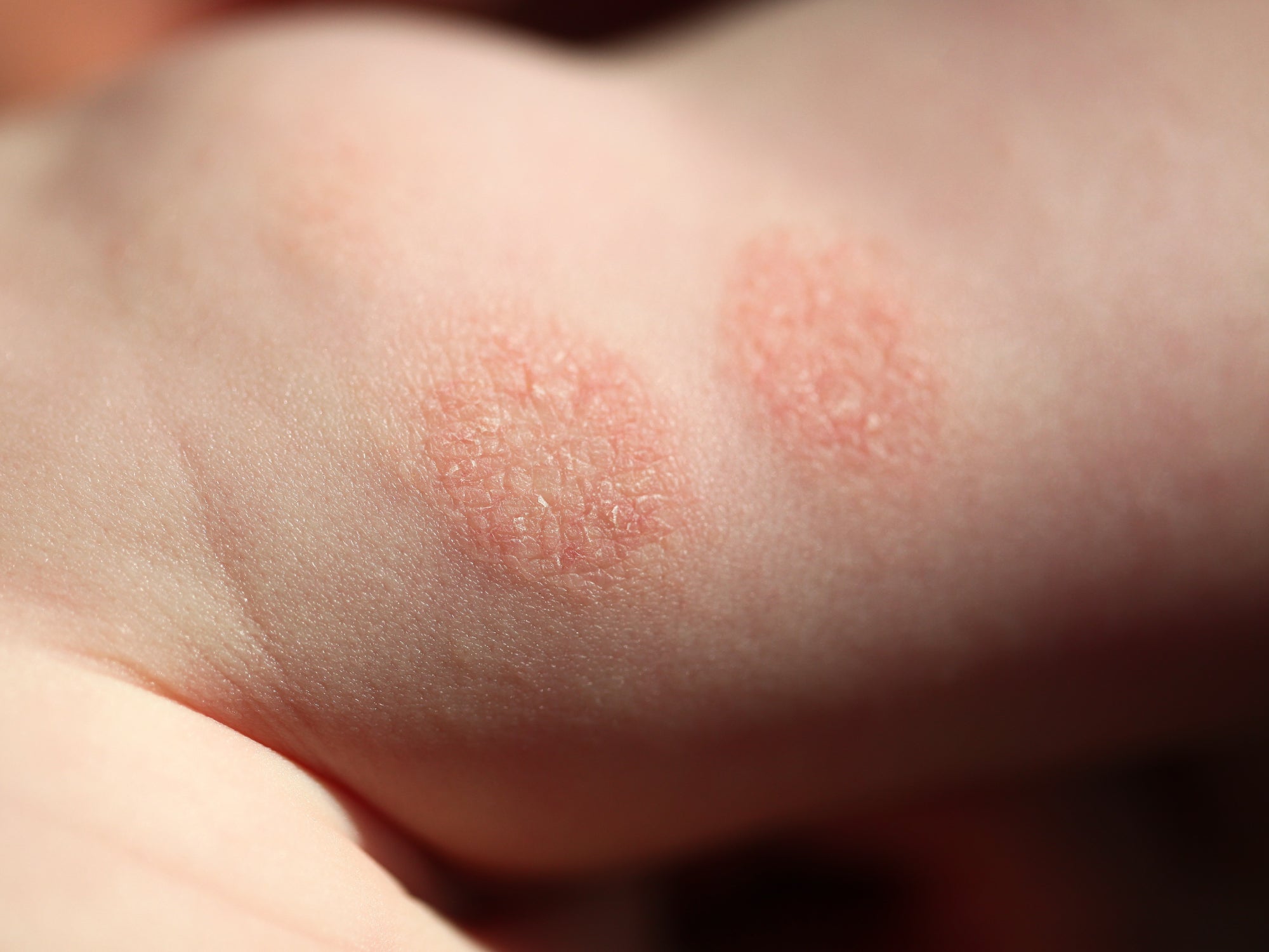 How Common Is Discoid Eczema? – Balmonds