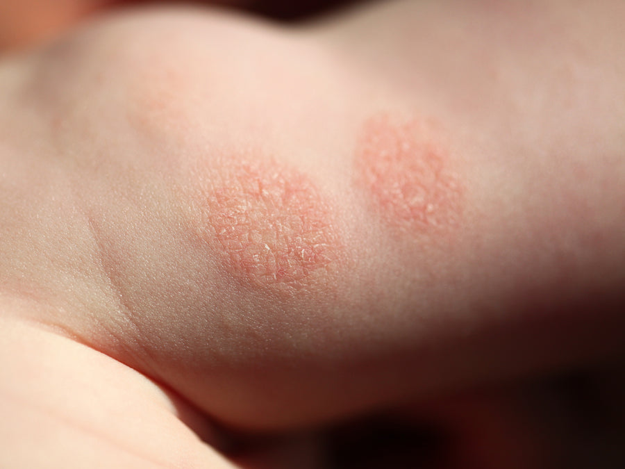 How Common Is Discoid Eczema?