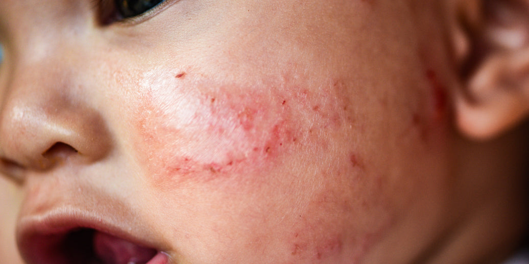 eczema on a babies face