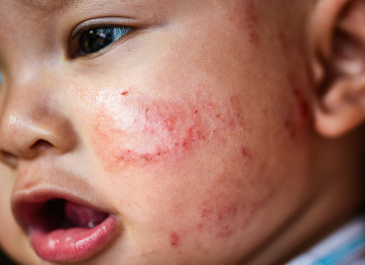 eczema on a babies face