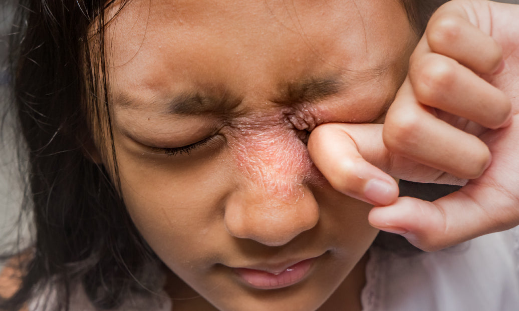 Young person with Periocular Dermatitis, rubbing their eye