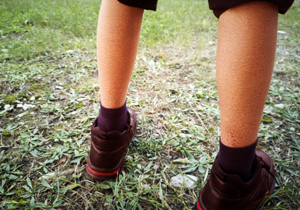  Ichthyosis on the back of lower legs