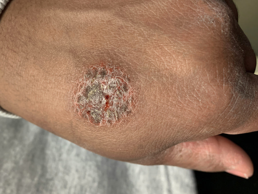 A patch of Discoid Eczema on the back of a hand