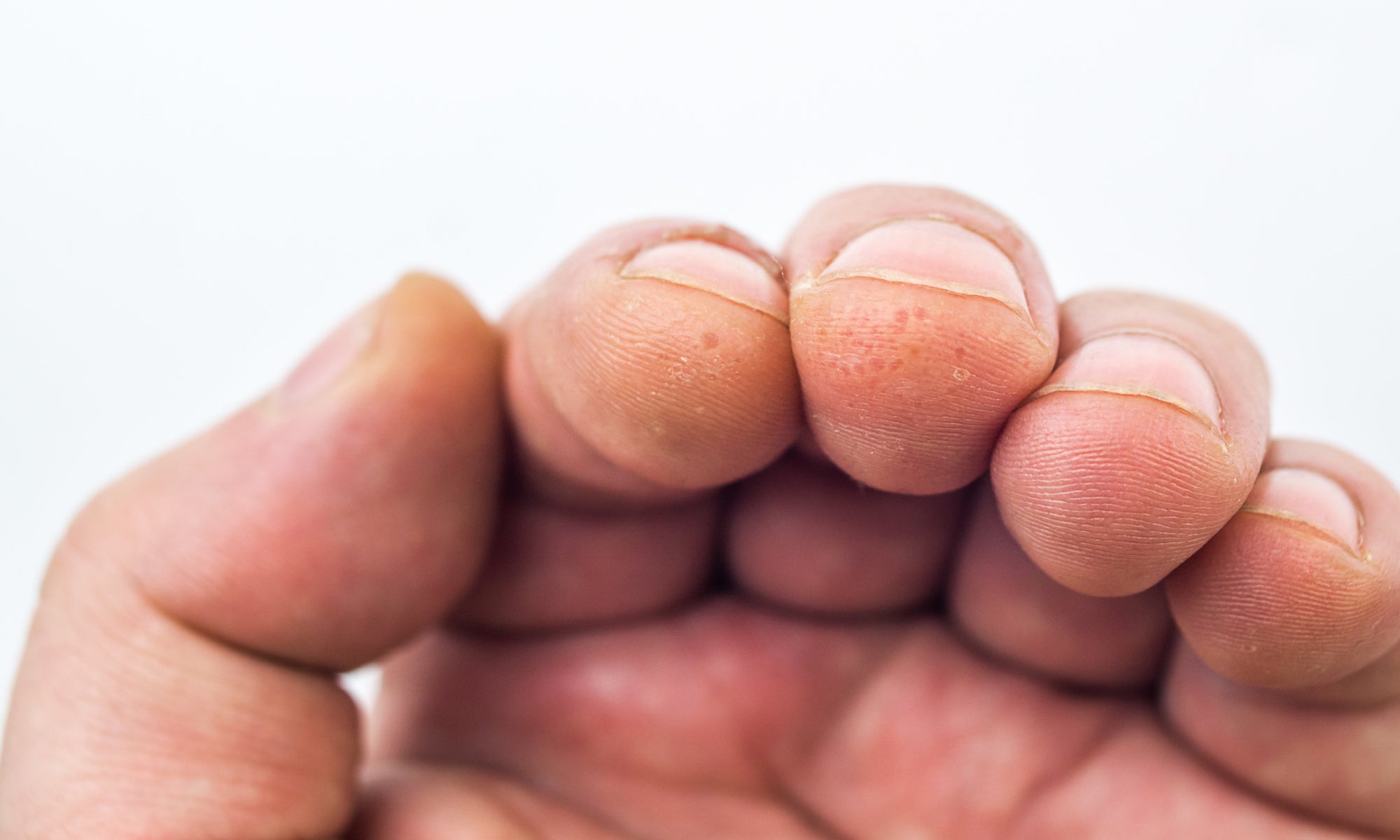 Dyshidrotic Eczema on the ends of fingers