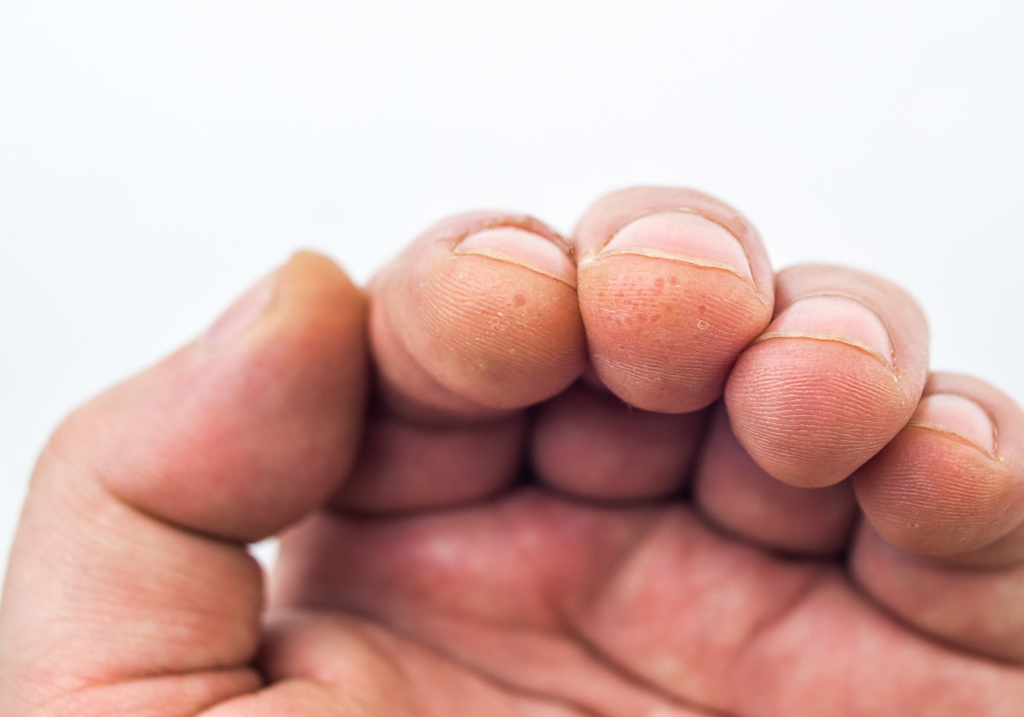 Dyshidrotic Eczema on the ends of fingers