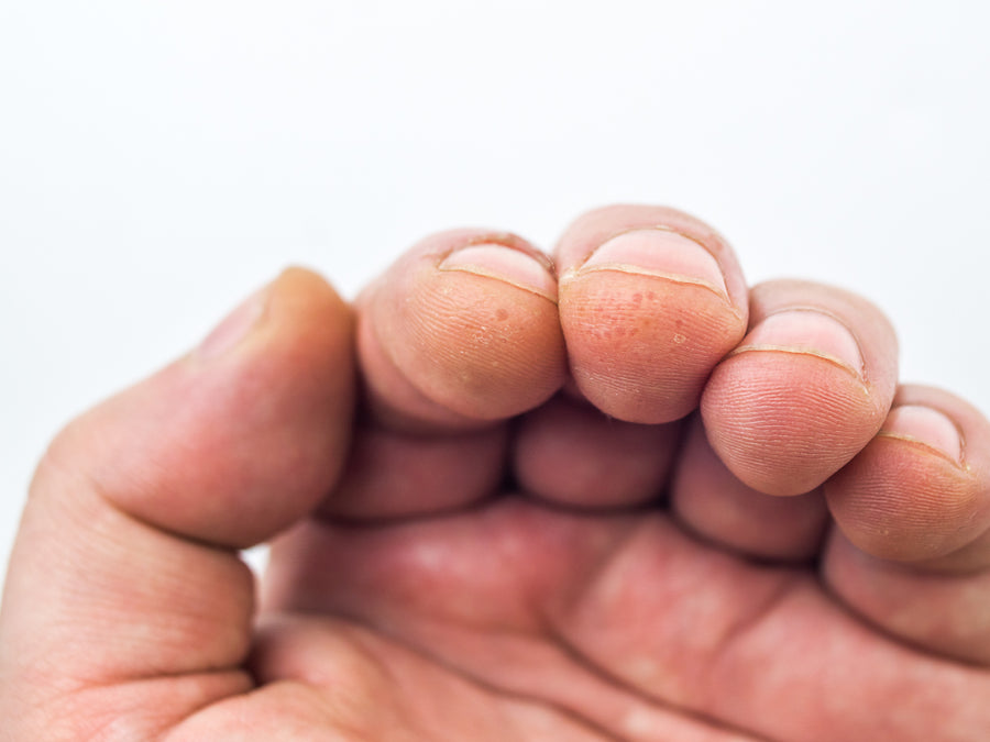 Dyshidrotic Eczema on the ends of fingers