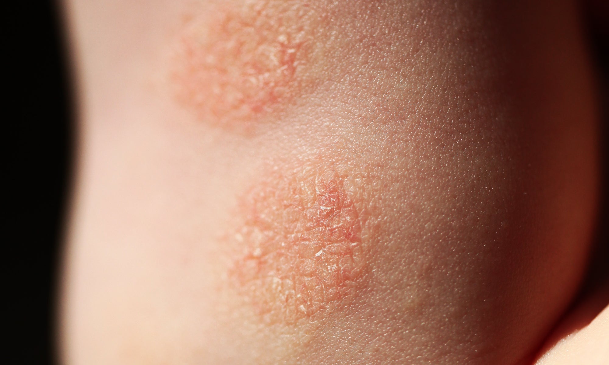 an example of discoid eczema