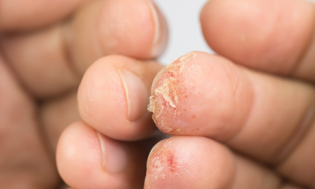 Dyshidrosis at the end of fingers