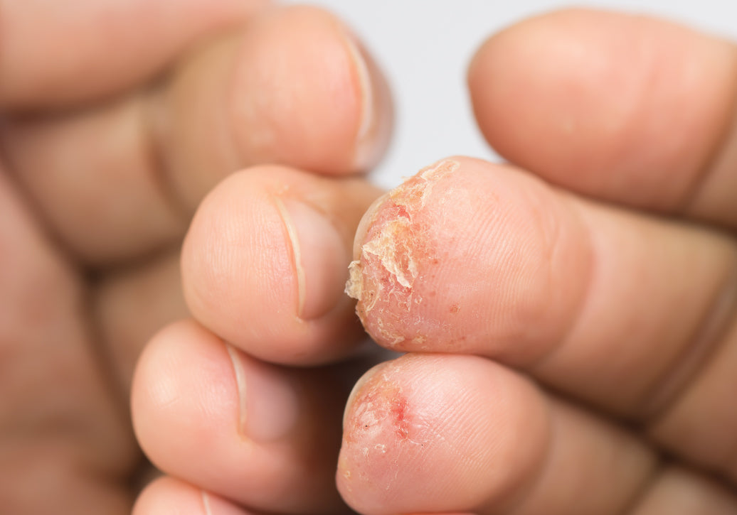 Dyshidrosis at the end of fingers