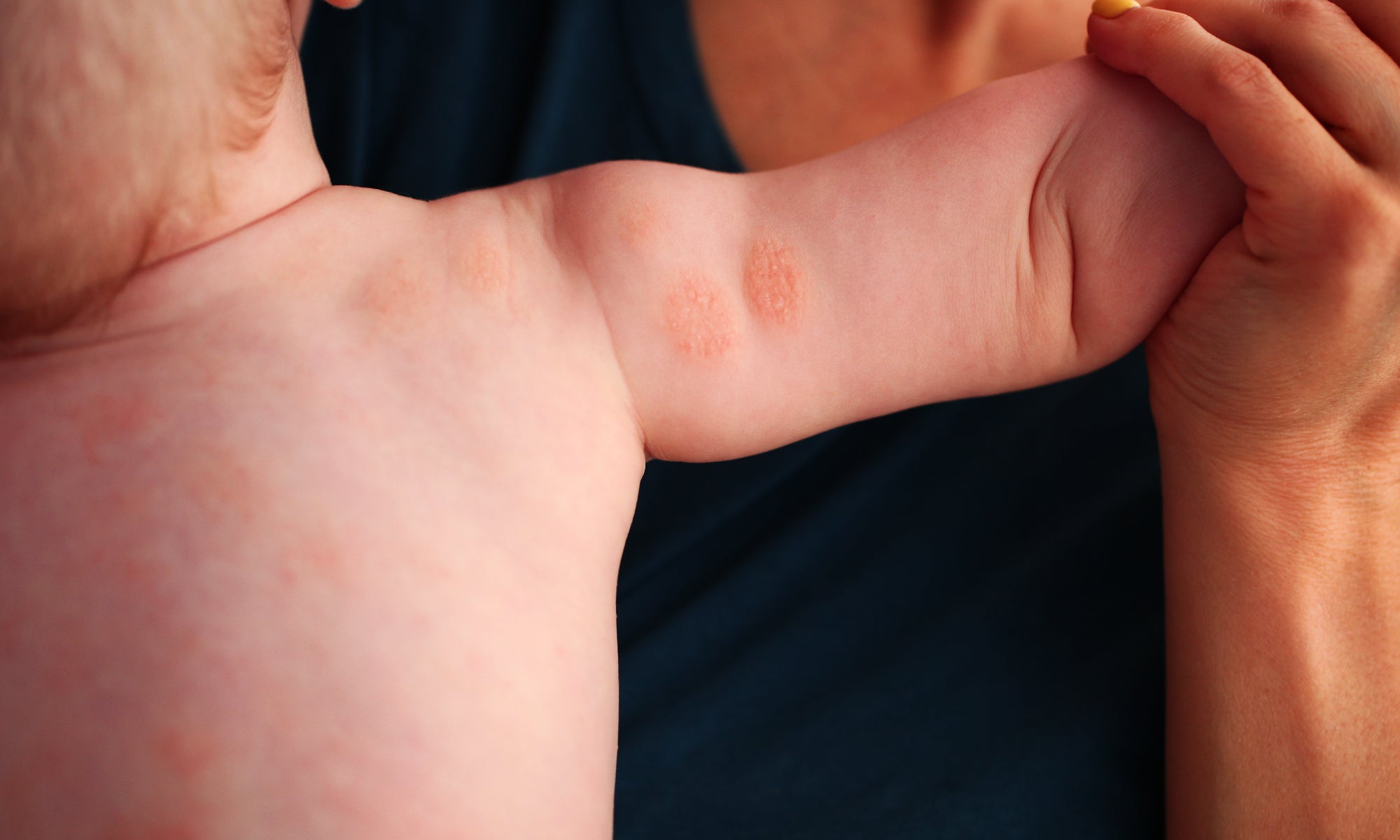 Some discoid eczema on the back of a babies arm